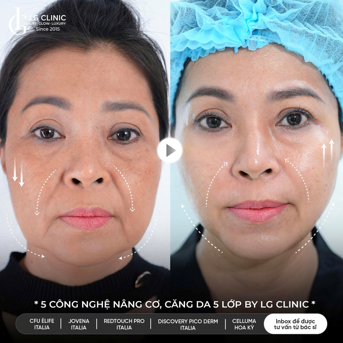 Công nghệ trẻ hóa khuôn mặt 5.5.10: Bí quyết trẻ ra 10 tuổi chỉ sau 60 phút mà không cần phẫu thuật- Ảnh 2. Công nghệ trẻ hóa khuôn mặt 5.5.10: Bí quyết trẻ ra 10 tuổi chỉ sau 60 phút mà không cần phẫu thuật- Ảnh 2.