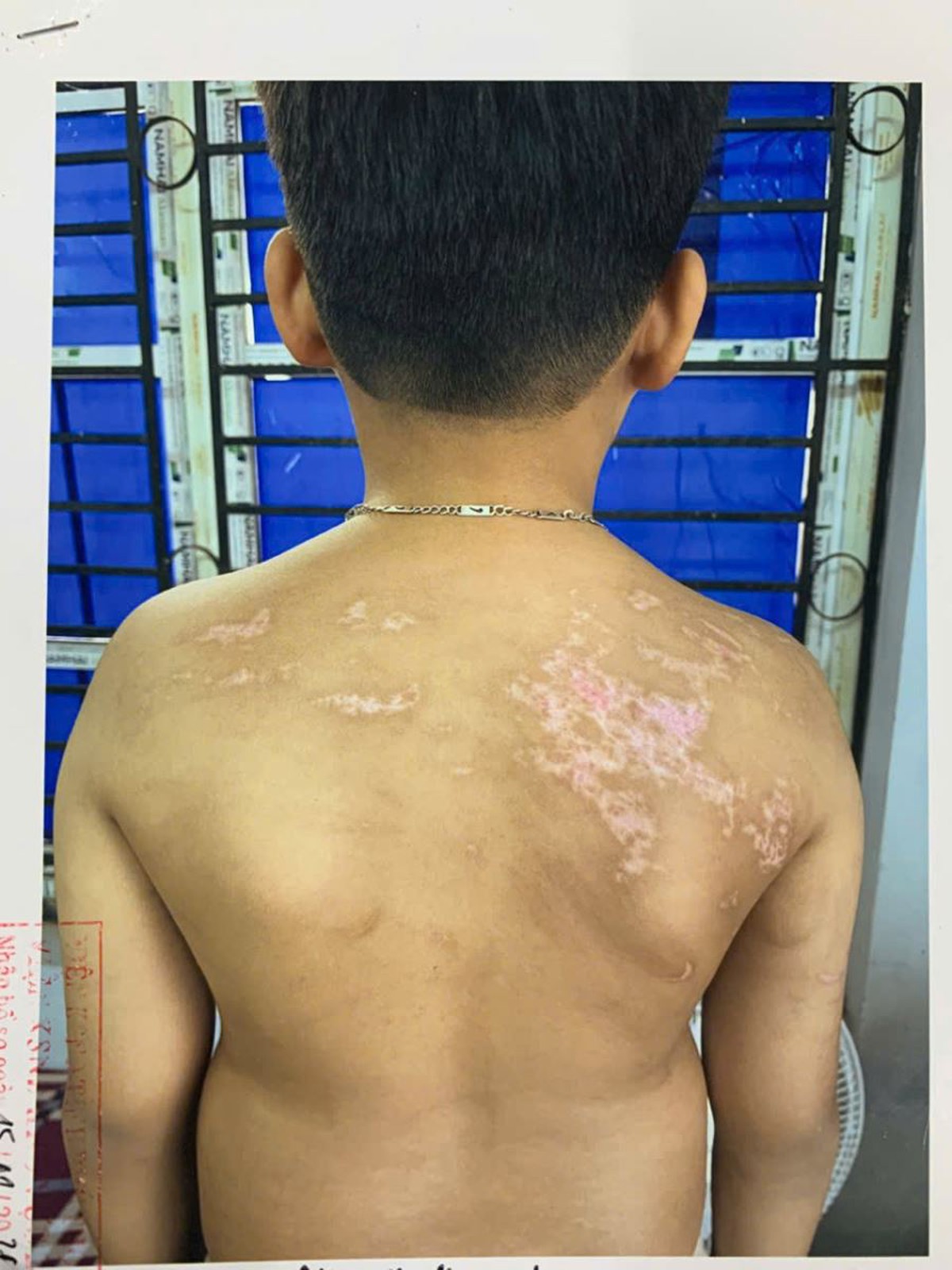 Bé trai 7 tuổi bị cha ruột đánh bằng dây sạc, thương tích 36%- Ảnh 2.