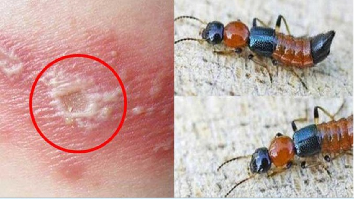 Khuyến cáo của chuyên gia về viêm da do kiến ba khoang và zona thần kinh- Ảnh 2. Khuyến cáo của chuyên gia về viêm da do kiến ba khoang và zona thần kinh- Ảnh 2.