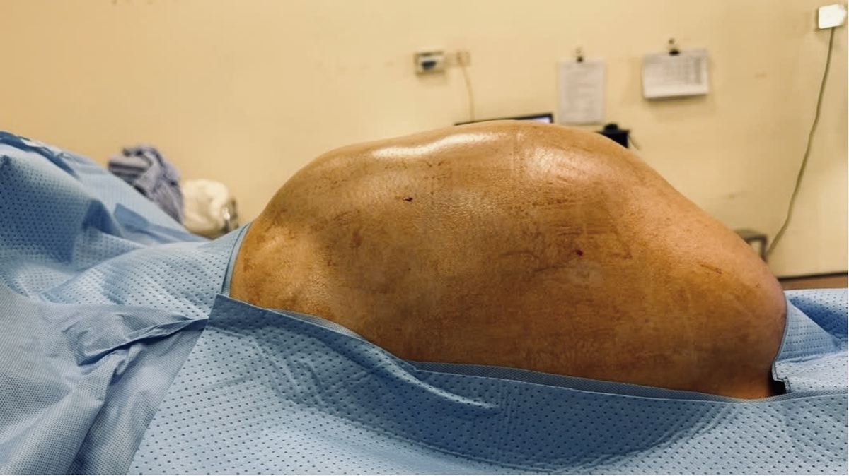 Nữ sinh 16 tuổi mang khối u buồng trứng gần 15kg được phẫu thuật thành công, bảo tồn khả năng sinh sản - Ảnh 1.