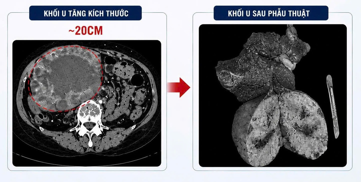 U gan từ 2cm tăng vọt lên 20cm vì tự uống thuốc nam tại nhà- Ảnh 1. U gan từ 2cm tăng vọt lên 20cm vì tự uống thuốc nam tại nhà- Ảnh 1.