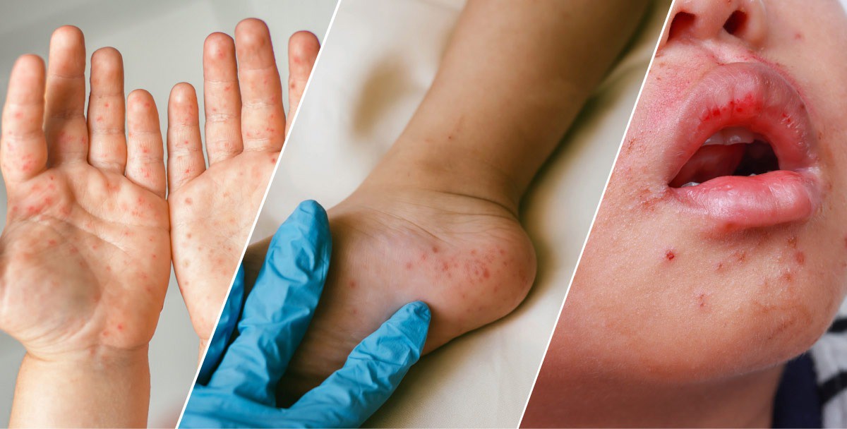 Tay chân miệng tăng nhanh trước mùa tựu trường: Trẻ dưới 5 tuổi nguy cơ cao - Ảnh 3.