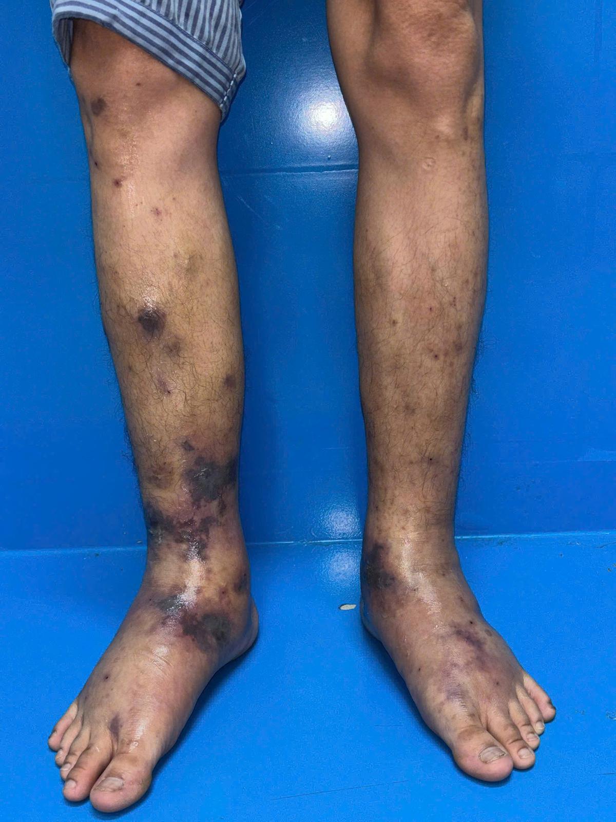 Bệnh viện Da liễu Trung ương điều trị thành công ca viêm mạch hiếm gặp - Ảnh 1.