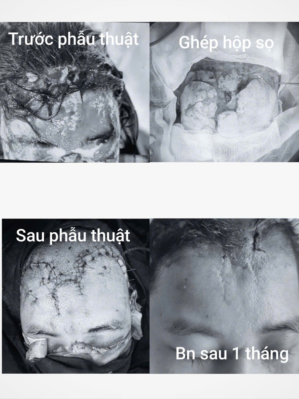 Chạy đua từng phút cứu nữ bệnh nhân tổn thương não nghiêm trọng sau tai nạn - Ảnh 1.