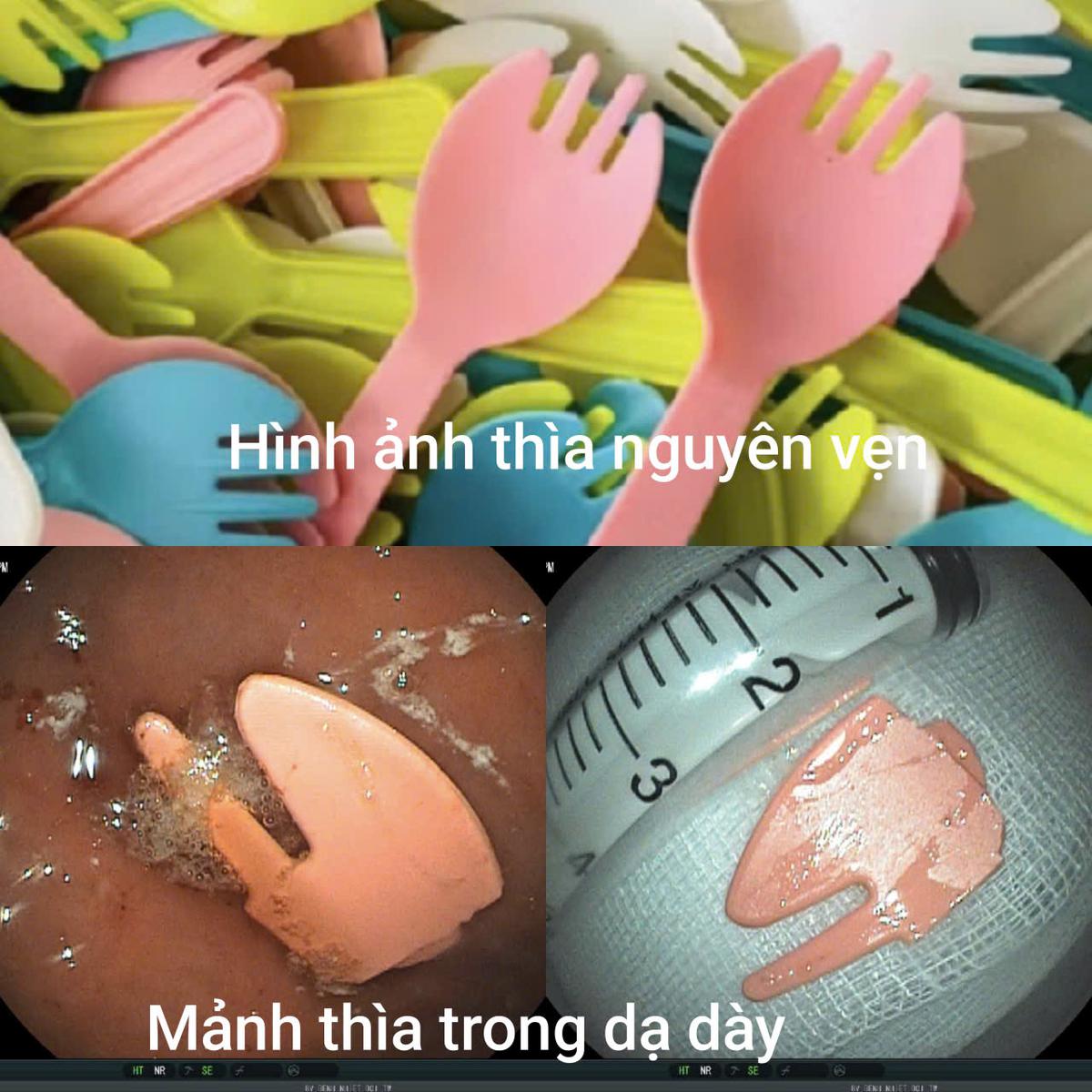 Nội soi cấp cứu lấy dị vật mảnh thìa nhựa cho bé 20 tháng tuổi- Ảnh 1.