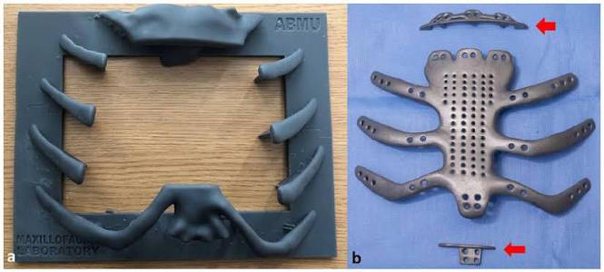 Cấy ghép toàn bộ lồng ngực in 3D cho bệnh nhân ung thư hiếm gặp - Ảnh 2.