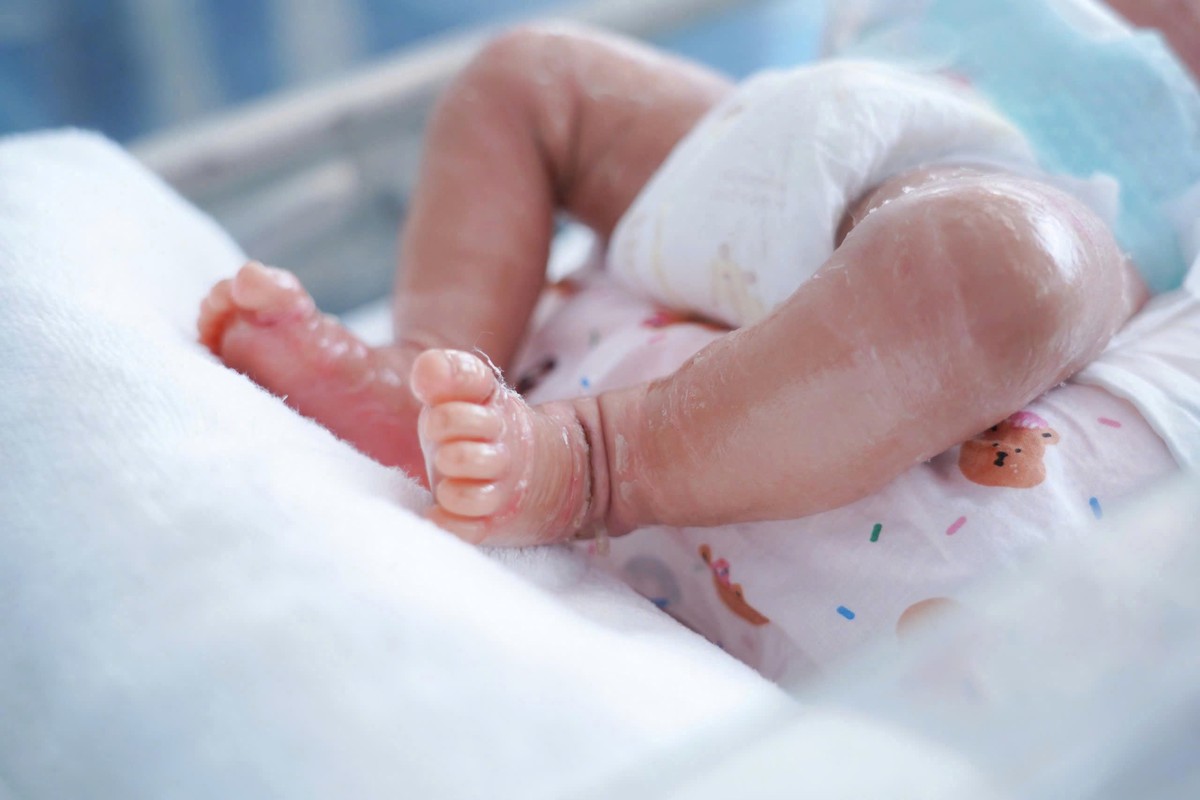 Bé trai sinh non mắc bệnh lý vảy cá bẩm sinh hiếm gặp- Ảnh 1.