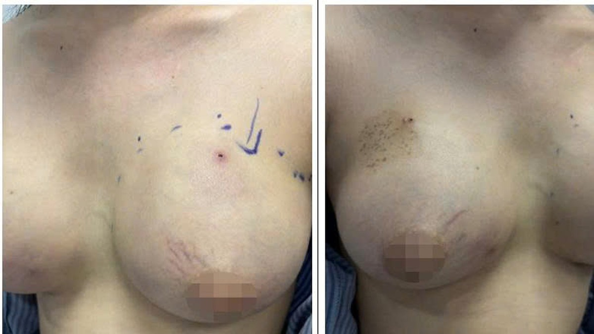 Tiêm filler nâng ngực tại nhà, cô gái 24 tuổi bị áp xe ngực- Ảnh 1.