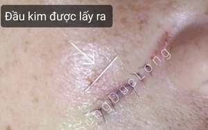 Tiêm filler tại tiệm làm tóc, nữ bệnh nhân hốt hoảng vì kim gãy trong má