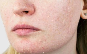 4 thứ cần bổ sung khi chăm sóc da khô mùa hè có thể bạn chưa biết!