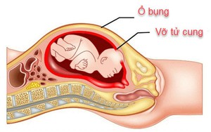 Cảnh báo vỡ tử cung trên bệnh nhân mổ đẻ cũ