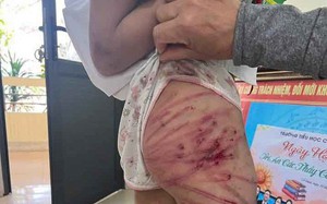 Đưa bé gái bị cha dượng bạo hành ở Hà Tĩnh về quê ngoại Sơn La sinh sống- Ảnh 3. Bé gái lớp 5 nghi bị người thân bạo hành: Công an vào cuộc
