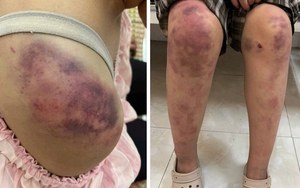 Mẹ bé gái bị bạo hành ở Thái Nguyên: 