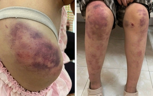 Vụ bé gái 13 tuổi bị bạo hành dã man ở Thái Nguyên: Vì sao tỷ lệ tổn thương cơ thể chỉ 5%?