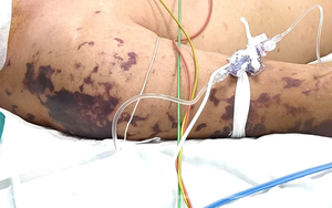 Bất ngờ sốc nhiễm khuẩn nguy kịch sau 48 giờ ăn cỗ