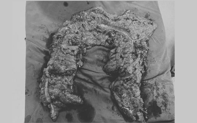 Nữ nội trợ U70 táo bón suốt 10 năm phải cắt gần như toàn bộ đại tràng- Ảnh 2.