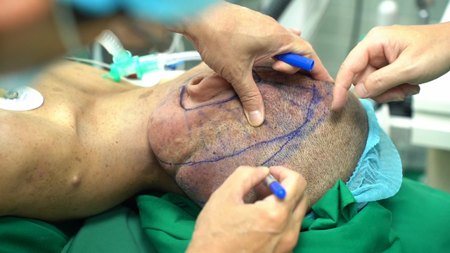 Bệnh viện Chợ Rẫy phẫu thuật thành công khối u sợi thần kinh khổng lồ- Ảnh 1.