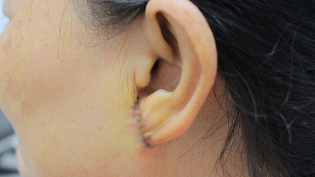 Sẹo ở tai phì đại, lở loét bất thường vì chần chừ đi khám- Ảnh 1.