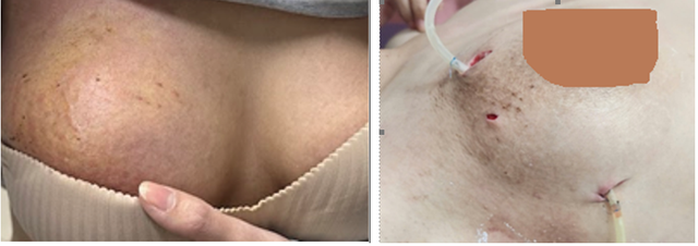 Áp xe vú nguy hiểm sau tiêm filler nâng ngực- Ảnh 1.