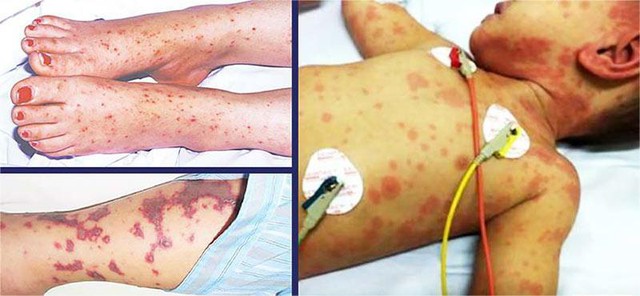 Viêm màng não mô cầu tăng mạnh - căn bệnh cứ 2 người mắc, 1 người có thể tử vong- Ảnh 1. Viêm màng não mô cầu tăng mạnh - căn bệnh cứ 2 người mắc, 1 người có thể tử vong- Ảnh 1.