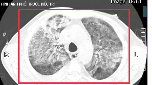 Bệnh nhân trở về từ Thái Lan nguy kịch do mang vi khuẩn cực nguy hiểm- Ảnh 1.