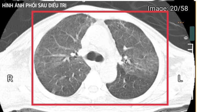 Bệnh nhân trở về từ Thái Lan nguy kịch do mang vi khuẩn cực nguy hiểm- Ảnh 2.