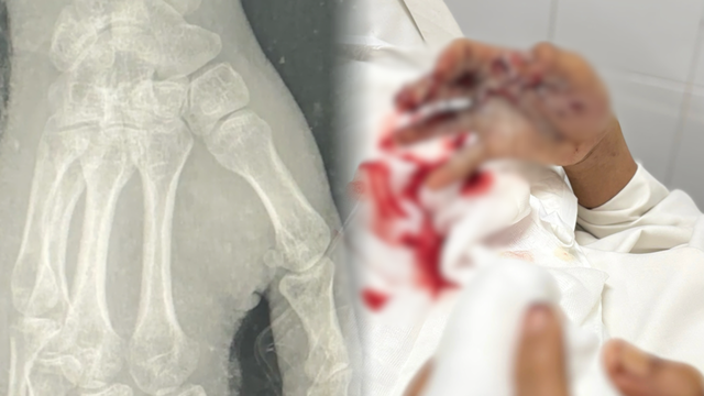 Liên tiếp ca cấp cứu đặc biệt nặng do pháo nổ dịp Tết Dương lịch- Ảnh 1.