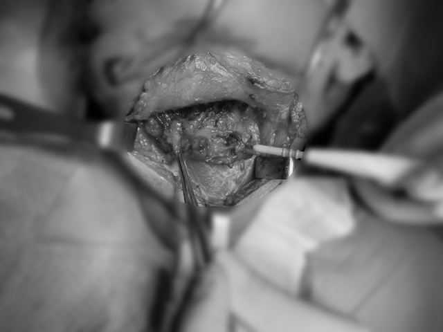 Tưởng viêm xoang, người phụ nữ không ngờ mắc bệnh lý hiếm gặp- Ảnh 1.