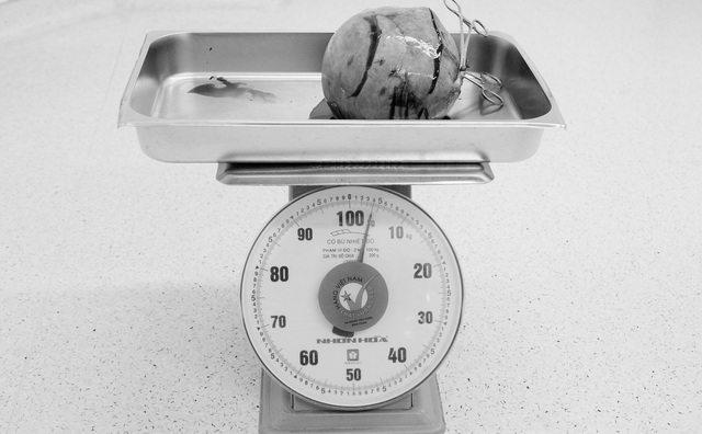 Phẫu thuật lấy khối u xơ tử cung to bằng quả bóng chuyền - Ảnh 2.