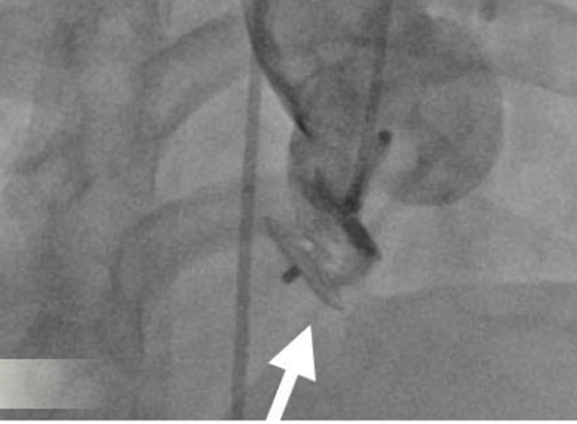 Cứu sống người phụ nữ bị bệnh lý tim mạch hiếm gặp- Ảnh 1.