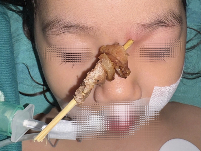 Que xiên thịt đâm xuyên vùng mắt bé gái 2,5 tuổi, gần chạm nền sọ não- Ảnh 2. Que xiên thịt đâm xuyên vùng mắt bé gái 2,5 tuổi, gần chạm nền sọ não- Ảnh 2.