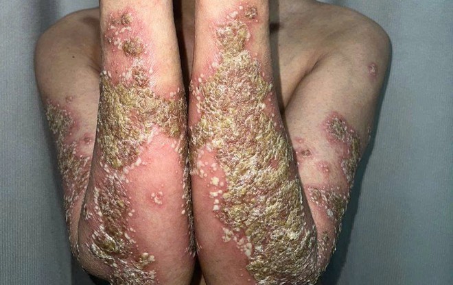 Nữ bệnh nhân dân tộc Mông đau đớn vì căn bệnh vảy nến mủ toàn thân- Ảnh 1. Nữ bệnh nhân dân tộc Mông đau đớn vì căn bệnh vảy nến mủ toàn thân- Ảnh 1.