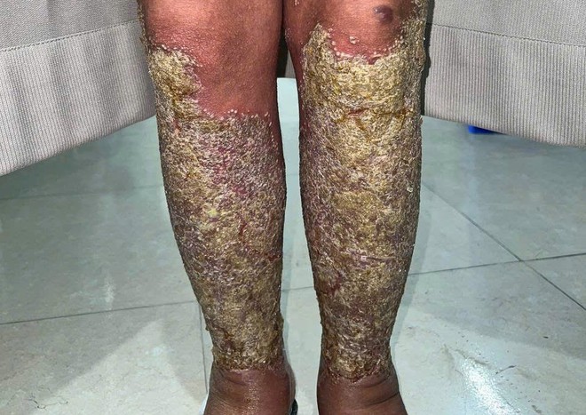 Nữ bệnh nhân dân tộc Mông đau đớn vì căn bệnh vảy nến mủ toàn thân- Ảnh 3. Nữ bệnh nhân dân tộc Mông đau đớn vì căn bệnh vảy nến mủ toàn thân- Ảnh 3.