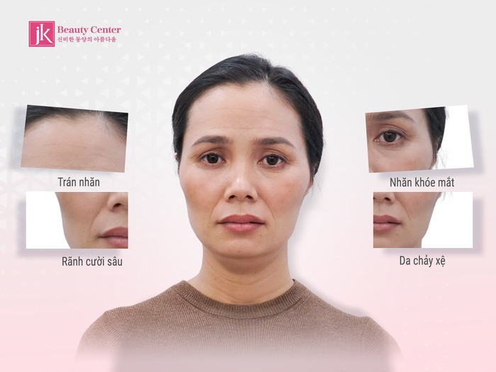 Dấu hiệu lão hoá trên gương mặt phụ nữ khi bước vào độ tuổi trung niên