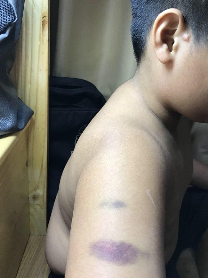 TPHCM: Một học sinh trường Quốc tế bị cô giáo đánh bầm tím tay - Ảnh 1.