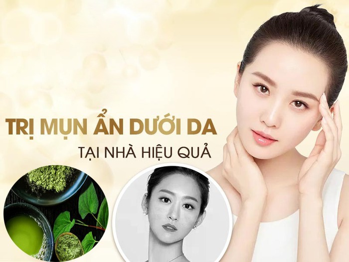 10 cách trị mụn ẩn dưới da tại nhà an toàn hiệu quả nhanh nhất - Ảnh 5.