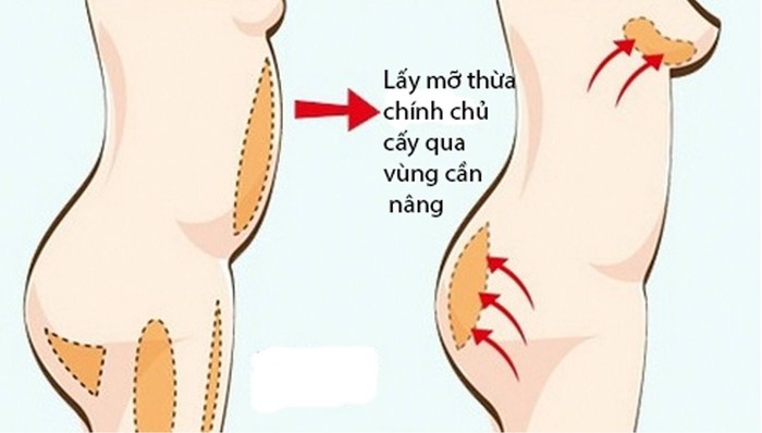 Những bộ phận an toàn cho kiểu làm đẹp hút mỡ chỗ thừa, &quot;đắp đầy&quot; chỗ thiếu nàng cần biết - Ảnh 2.