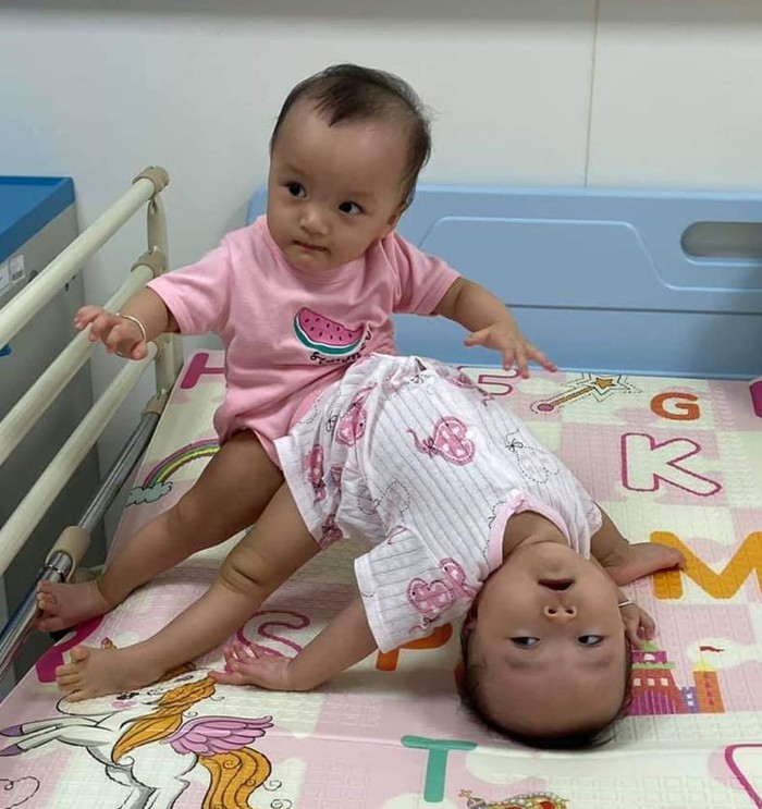 Đại phẫu tách dính bé gái song sinh: Người mẹ trẻ khóc lặng ngoài phòng mổ - Ảnh 3.