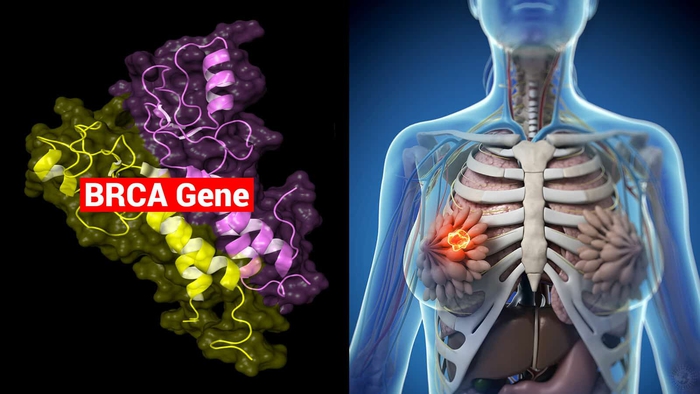 Nguy cơ ung thư vú do gene BRCA và cách hạn chế rủi ro - Ảnh 1.