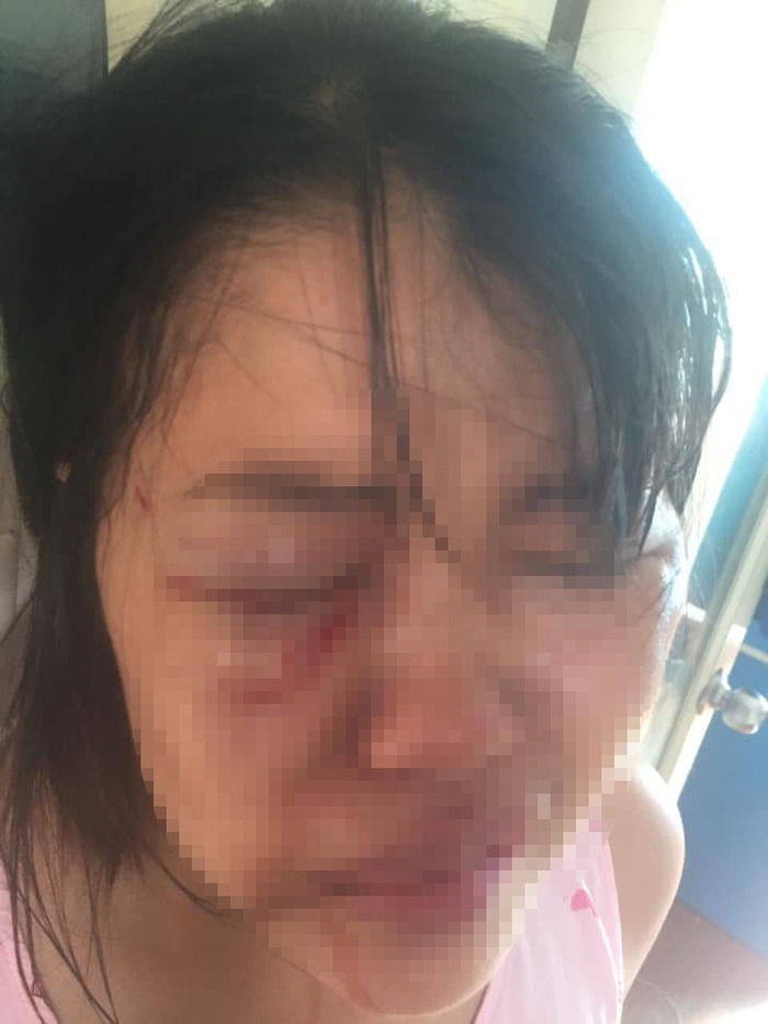 Nữ nhân viên hãng taxi Anpha &quot;tố&quot; bị chồng bạo hành dã man - Ảnh 1.