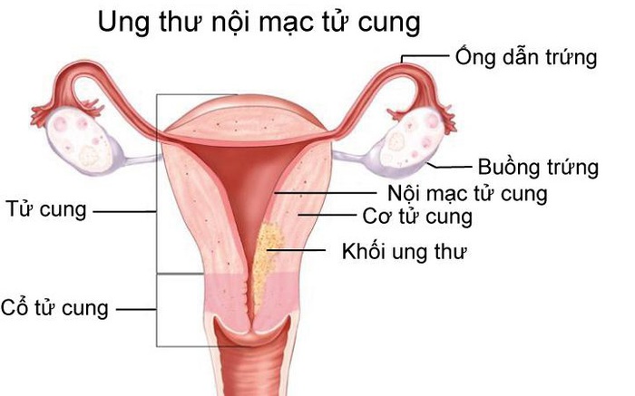 Nội Mạc Tử Cung 3mm: Ảnh Hưởng Và Phương Pháp Cải Thiện Hiệu Quả