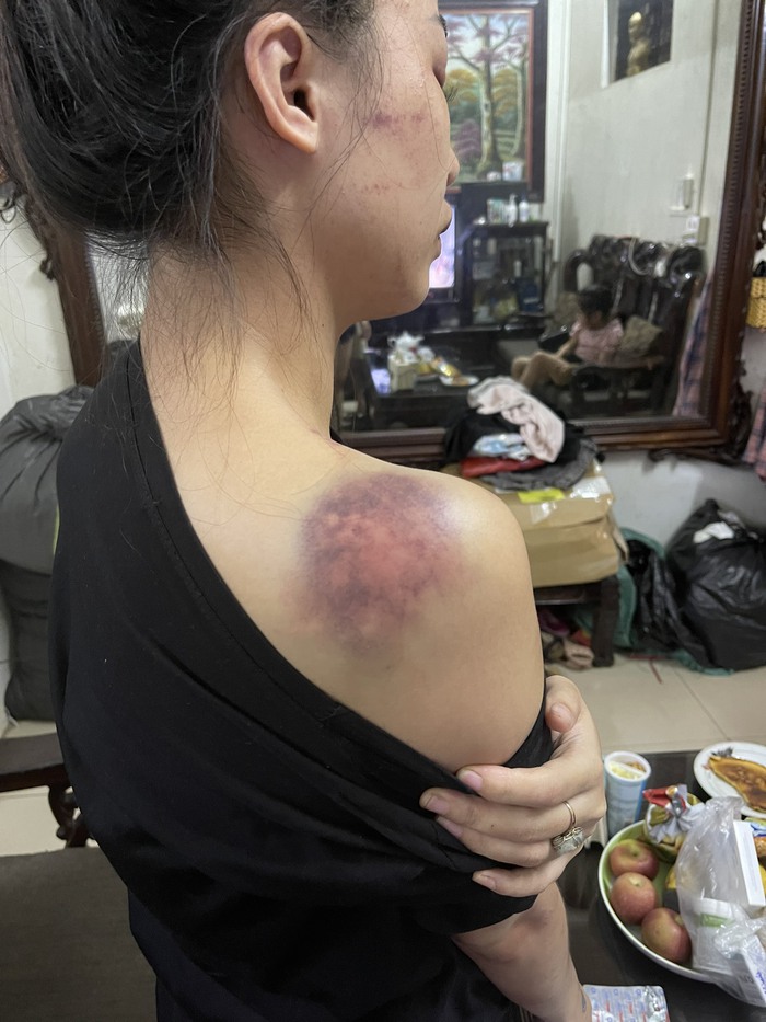 Người phụ nữ bị chồng đánh đập dã man ở Yên Bái: Hội LHPN tỉnh đề nghị xử lý nghiêm - Ảnh 2.