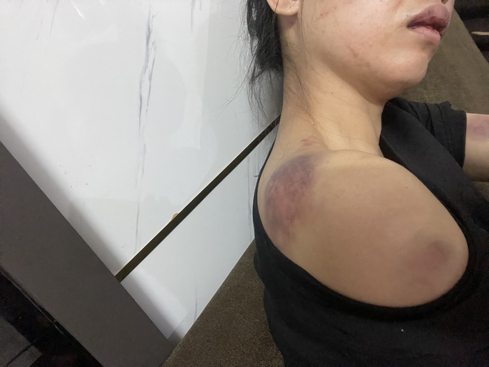 Người phụ nữ bị chồng đánh đập dã man ở Yên Bái: Hội LHPN tỉnh đề nghị xử lý nghiêm - Ảnh 1.
