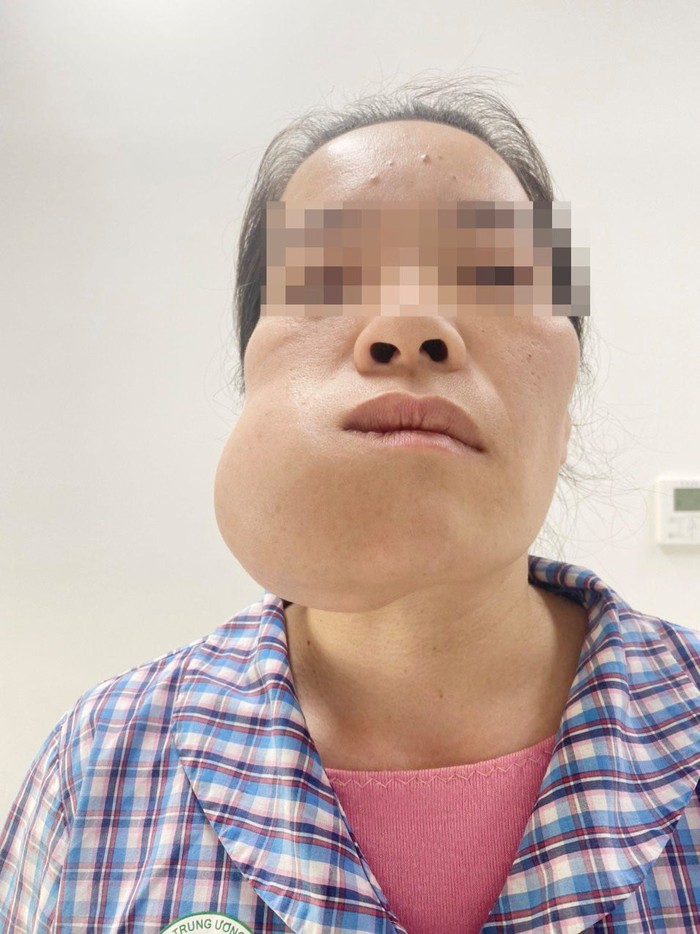 Giải cứu người phụ nữ 8 năm mang khối u khủng trên mặt - Ảnh 1.