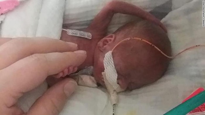 Em bé sinh non nhất thế giới đã đón sinh nhật đầu tiên sau khi đánh bại tỷ lệ sống sót là 0% - Ảnh 1.