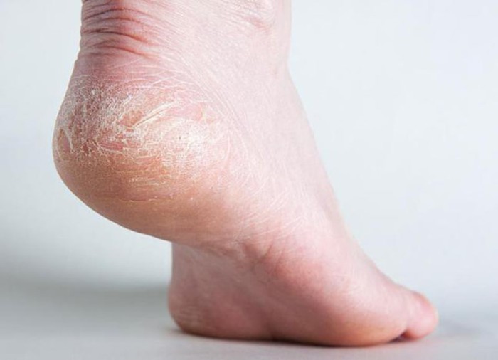 Gót chân bị tróc da là bệnh gì? Làm thế nào để cải thiện? - Ảnh 1.