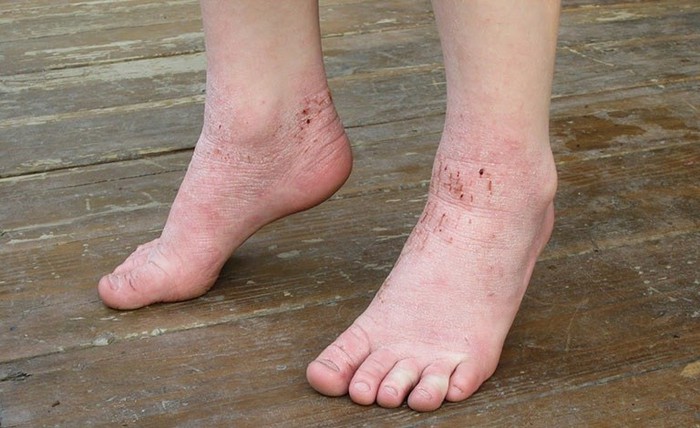 Gót chân bị tróc da là bệnh gì? Làm thế nào để cải thiện? - Ảnh 2.