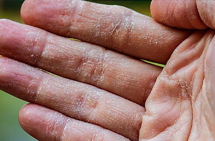 Cách chăm sóc da và phòng ngừa bệnh á sừng vào mùa đông - Ảnh 2.