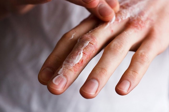 Cách chăm sóc da và phòng ngừa bệnh á sừng vào mùa đông - Ảnh 3.