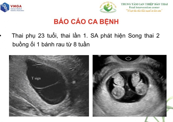 Ghi nhận trường hợp đầu tiên mang song thai cùng trứng nhưng khác kiểu hình và kiểu gene      - Ảnh 2.